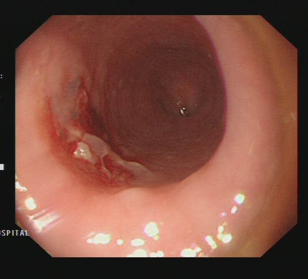 取魚刺胃鏡-3（內(nèi)鏡下可見穿孔部位）.png